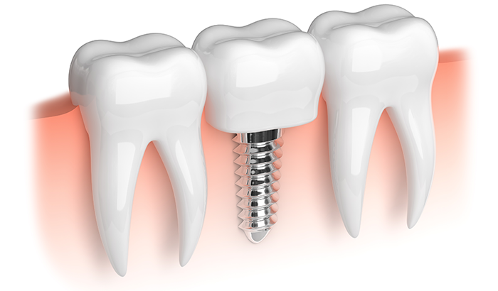 3d rendering of a dental implant